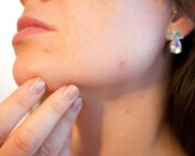 Pitta Skin is often inflamed and reddish. Ayurvedic treatments can help support skin health.