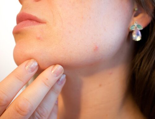 Ayurvedic Skin Care for Pitta Skin